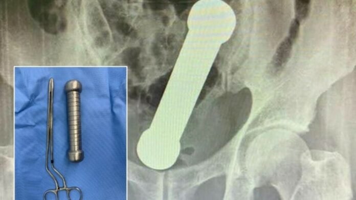 54-year-old Brazilian man shoved dumbbell in his rectum; seeks surgeons help to get it out